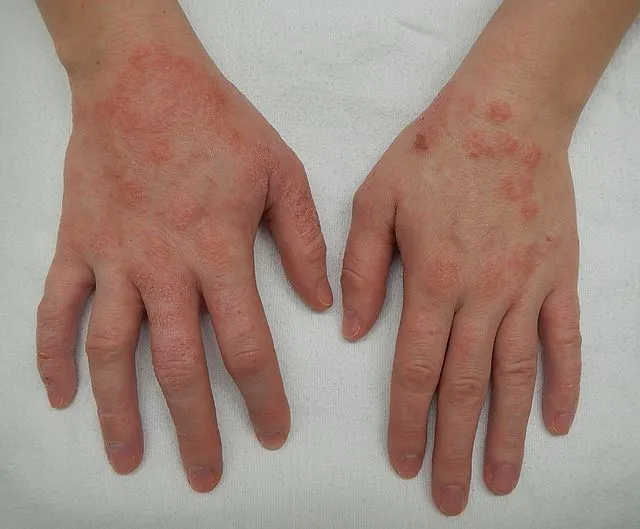 eczema, skin allergy, dermatology, skin care, allergy test, Casablanca Maroc