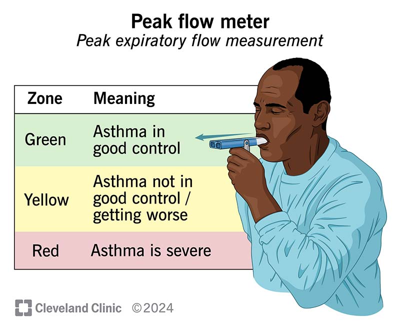 You are currently viewing Asthme pollinique